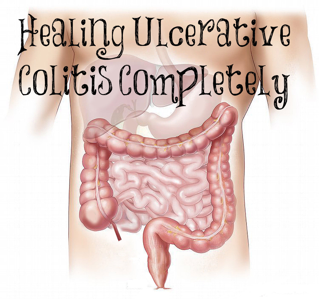 Healing Ulcerative Colitis Completely – The Transformed Wife